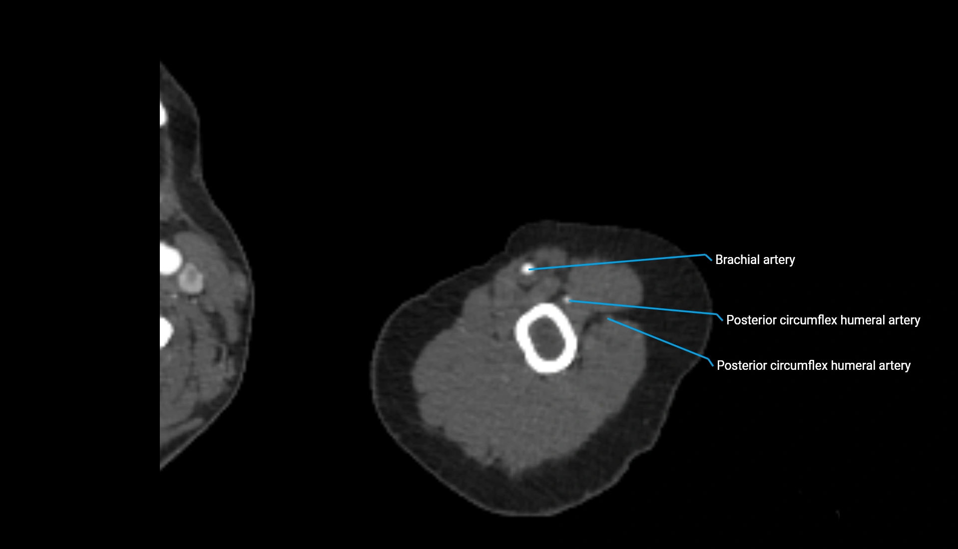 CTA upper limb axial cross sectional anatomy labelled image 302 (2).webp